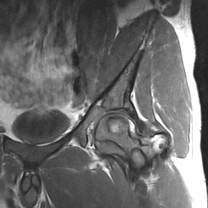 Coronal T1- Quadril esquerdo - estudo de caso - Telelaudo